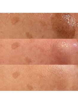 プルメリア(Plumeria)/シミケア経過段階