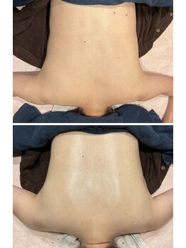 アメリオレ(ameliorer)/《ハーブピーリング》