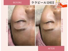 ラシック(La chic)/毛穴洗浄/ララピール心斎橋大阪