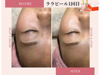 ラシック(La chic)/毛穴洗浄/ララピール心斎橋大阪