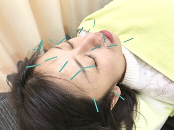 岩槻ミライエ鍼灸接骨院/小顔になりたい方にもおすすめ♪
