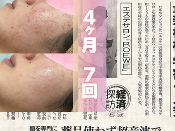 ロエヴェ(ROEWE)/ニキビ改善とニキビ後のケア