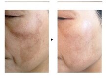 ケートータルビューティー(K. total beauty)/純粋レチノールピールエステ2