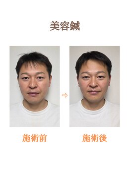 ユラ鍼灸サロン(YURA鍼灸サロン)/美容鍼