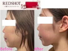 アファン 鶴見店(Afun)/【レッドショット】40代脂肪分解