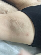 ナノハナ/鹿沼市の全身脱毛のナノハナ