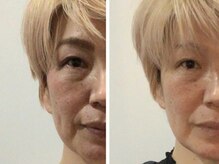 リテルナ(Re.terna)/■ニードルレスインジェクター