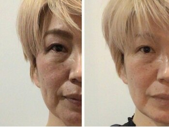 リテルナ(Re.terna)/■ニードルレスインジェクター