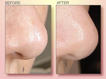 ジュリア オージェ 天王寺店/ビフォーアフター（鼻スパ）