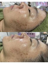 アイラッシュネイルサロン ブリエ(Briller)/プラズマフェイシャル 効果