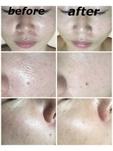 クリスタルボウ(Crystal BEAU)/カーボンピーリングフォト3回