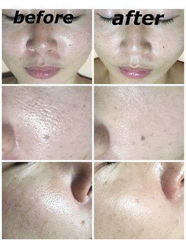 クリスタルボウ(Crystal BEAU)/カーボンピーリングフォト3回