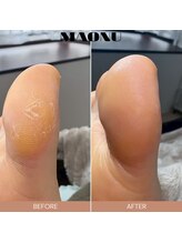 マオヌー(MAONU)/韓国式足裏角質ケア　症例写真