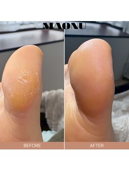 マオヌー(MAONU)/韓国式足裏角質ケア　症例写真