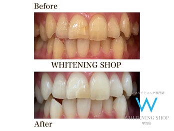 ホワイトニングショップ 甲賀店/Before&After『ホワイトニング』