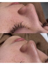 ラヴィン なんばスカイオ店(Lovin)/【水素ハイドロ毛穴洗浄1回】