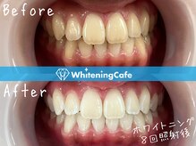 ホワイトニングカフェ 姫路駅前店(WhiteningCafe)/ホワイトニング8回照射
