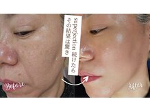 水光ピールスキン/当店1番結果コースSUPERJECTION