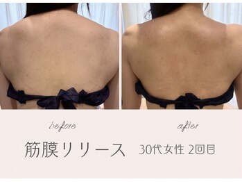 アールエスト(R EST.)/筋膜リリース×肩甲骨はがし☆