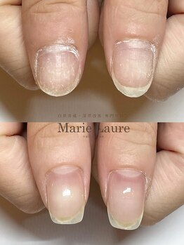 マリーロール 梅田店(Marie Laure)/自爪育成/深爪矯正/ネイルケア
