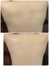 エステサロン 美飾り イオンモール木更津店/before⇒afteｒ/背中ニキビ