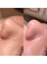 ジョイビー 新宿本店(JoyBee)/【 JoyBee式毛穴洗浄】症例写真