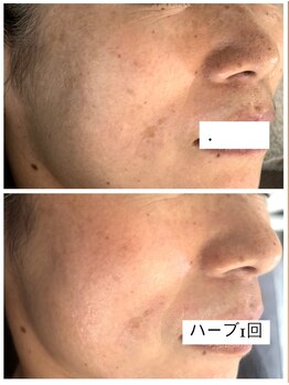 カムイ/ハーブピーリング1回剥離あり