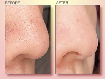 ジュリア オージェ 天王寺店/ビフォーアフター（鼻スパ）