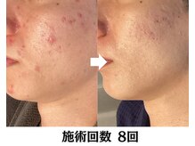 バース(Birth...)/ハーブピーリング/ニキビケア