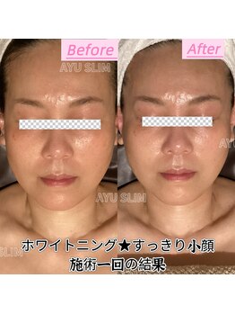 アユスリム(AYU SLIM)/一回でも変化できるの充実小顔