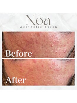 ノア 新宿(Noa)/ハーブピーリング+マシン1回