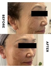 リミュール(Ri.miyuru)/8回でここまで変化◎