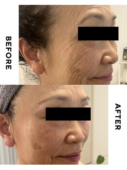 リミュール(Ri.miyuru)/8回でここまで変化◎