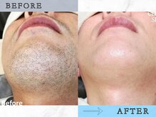 ラッシュ(RUSH)/約１年でヒゲ脱毛完了！