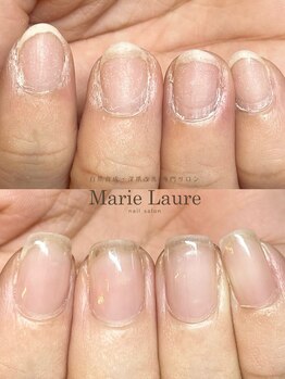 マリーロール 梅田店(Marie Laure)/自爪育成/深爪矯正/ネイルケア