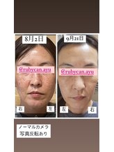 ナナラ(nanala)/シミケアのスキンケア★