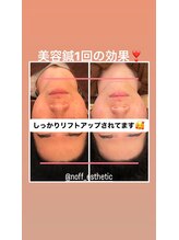 ノフ 恵比寿(noff)/効果）美容鍼 bf→af