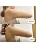 【二の腕/ハミ肉集中ケア◆】ラジオ派×超音波×脂肪冷却痩身 ¥5,500→¥2,500