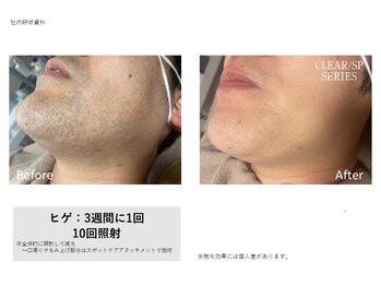 ベスト(BEST)/ヒゲ脱毛