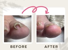 ドクターネイル爪革命 恵庭店/巻き爪ケア