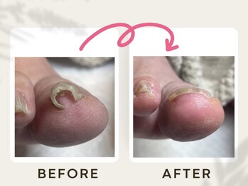 ドクターネイル爪革命 恵庭店/巻き爪ケア