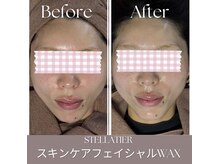 ステラティエ(Stellatier)/シミ/シワ/たるみ/リフトアップ
