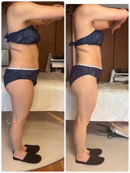 ジフィー(Gify)/筋膜リリースカッターBody 4回