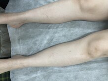 ナノハナ/鹿沼市の全身脱毛のナノハナ