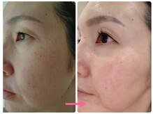 アズ(AZU)/40代before after