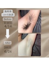 ネイチャー(Nature)/【脇脱毛ビフォアフ】