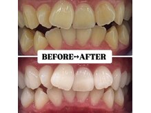 ホワイトニングサロン 豊中/Before&After美白ホワイトニング