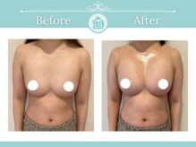 美人バスト 沼津店/【バストアップ★育乳】症例！！