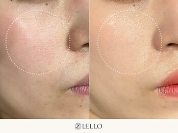 レロ 恵比寿店(LELLO)/冬の乾燥対策を強化したい方へ