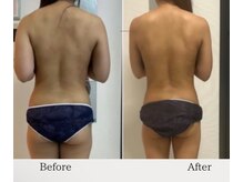 オーシャンブルーム 目黒(OceanBloom)/リンパマッサージハイパーナイフ